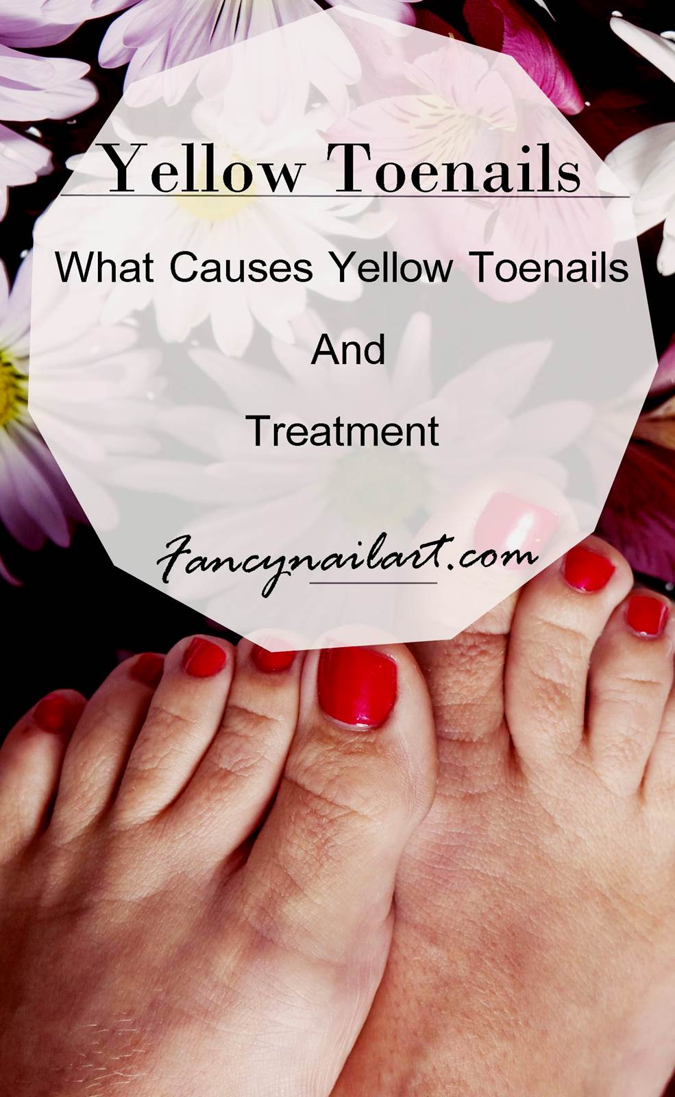 Yellow Toenails -What Causes Yellow Toenails And Treatment