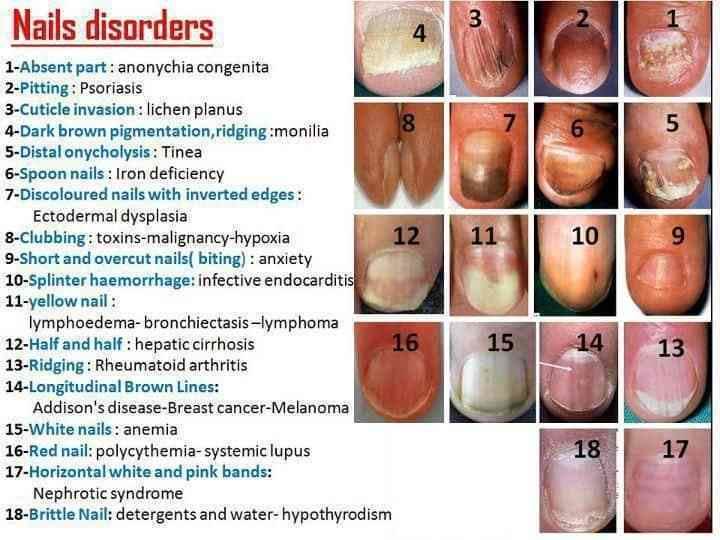 Nail abnormalities: MedlinePlus Medical Encyclopedia - wide 1