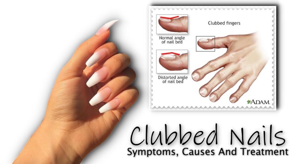 Clubbed Nails : Symptoms, Causes And Treatment 
