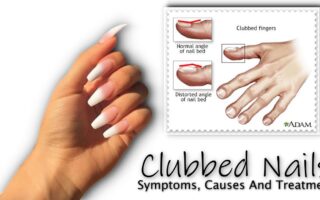 Clubbed Nails : Symptoms, Causes And Treatment