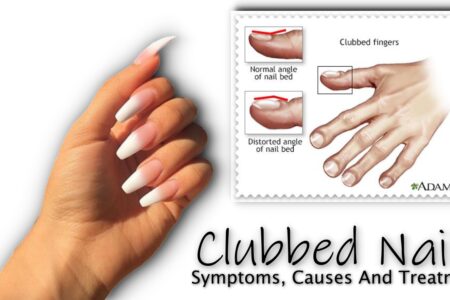 Clubbed Nails : Symptoms, Causes And Treatment